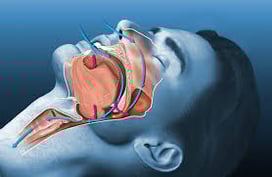 APNEA DEL SUEÑO-1