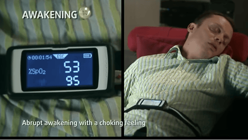Apnea HTA