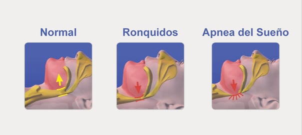 Normal ronquido apnea