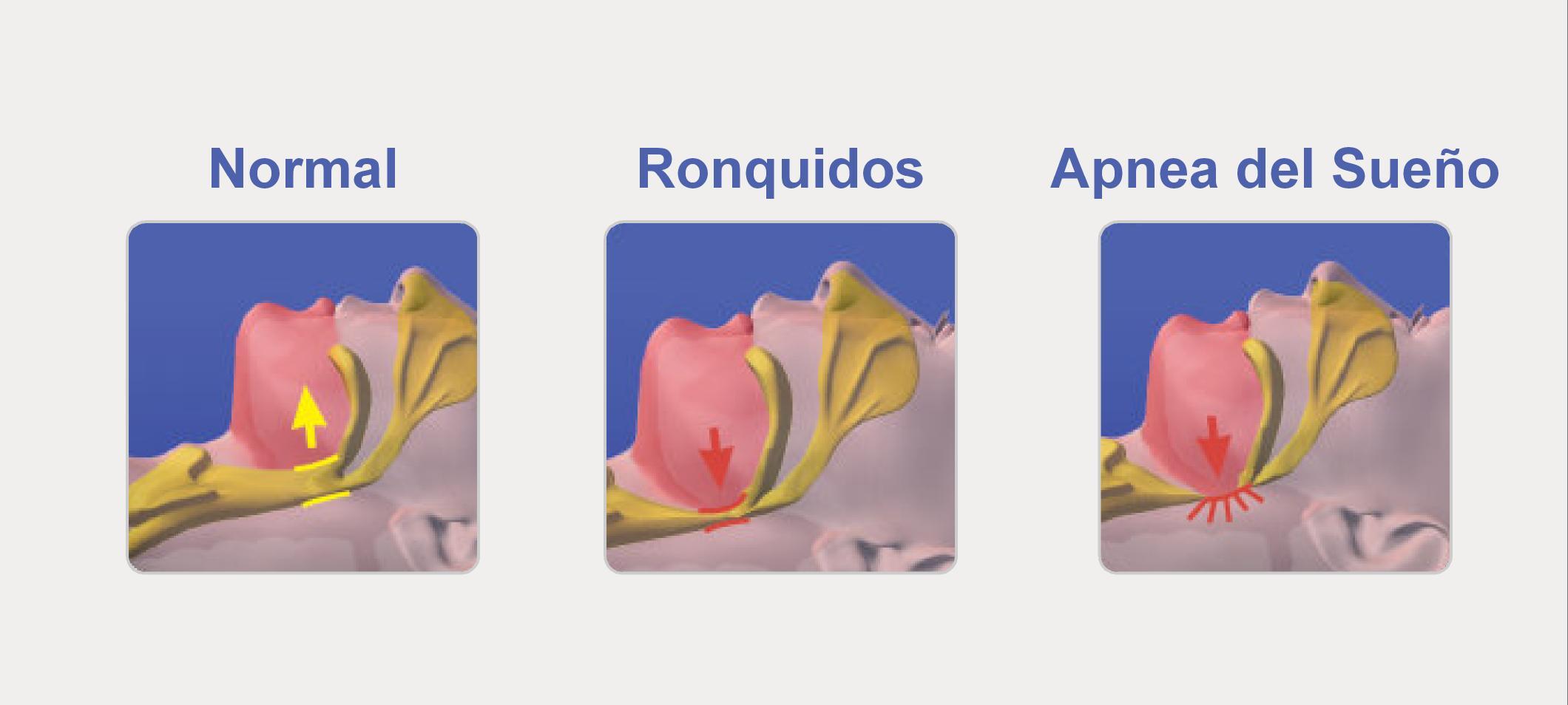 Normal ronquido apnea