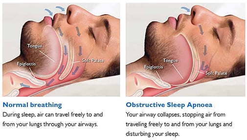 Normal y apnea