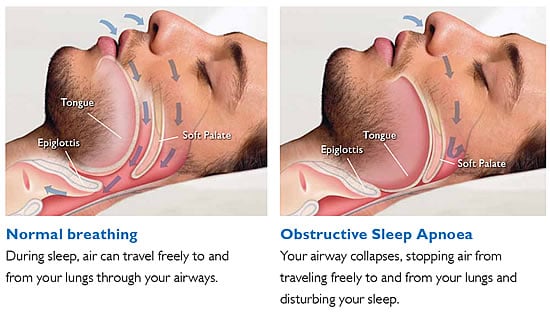 Normal y apnea